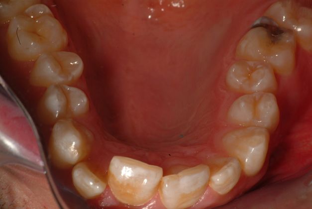 Invisalign Case 2