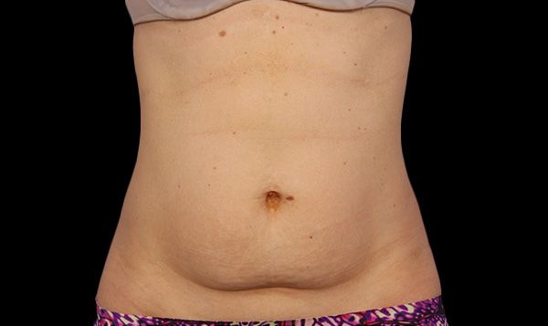 A woman's abdomen before liposuction
