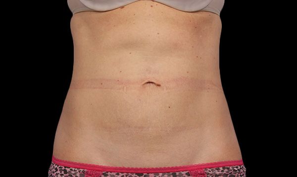 A woman's abdomen after liposuction