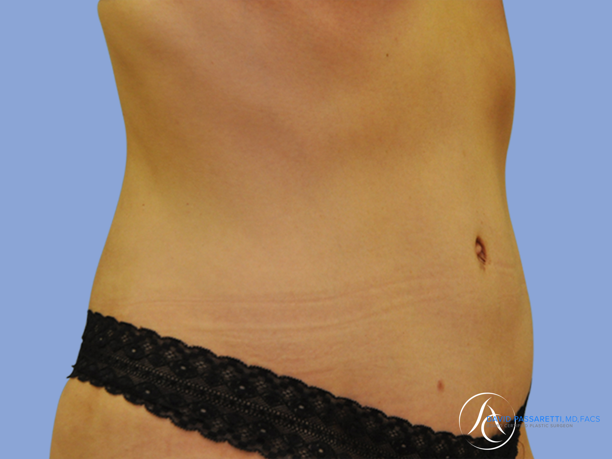 after tummy tuck