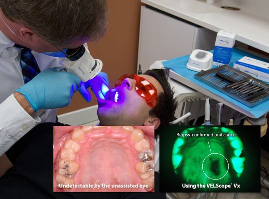 VELscope® Oral Cancer Screenings