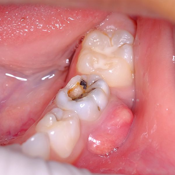 Tooth with advanced cavity