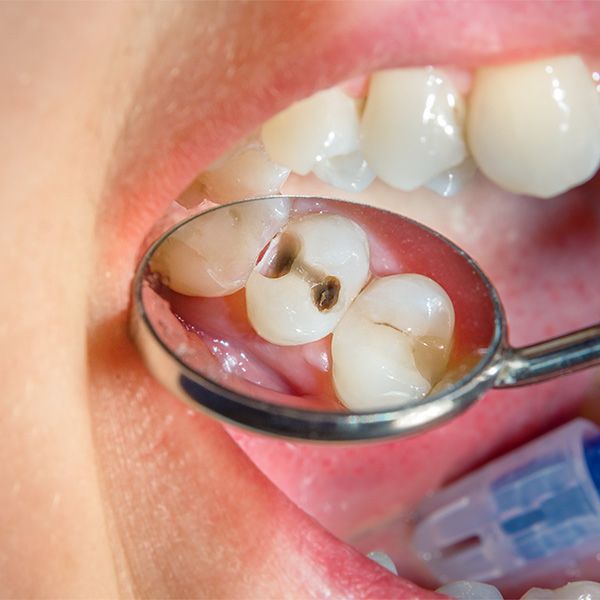 Decayed tooth reflected in dental mirror