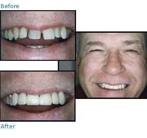 Before and after dental patient pictures