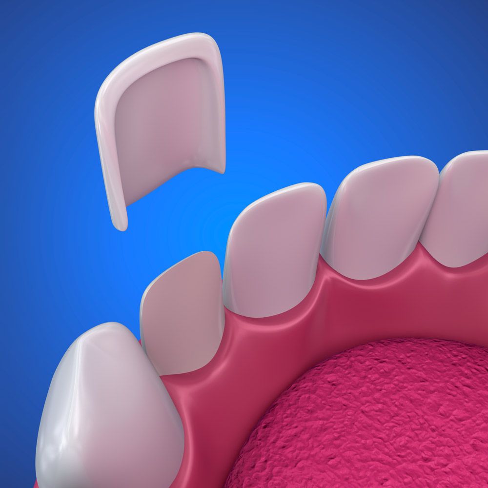 Porcelain veneers