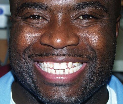 Before and after porcelain veneers