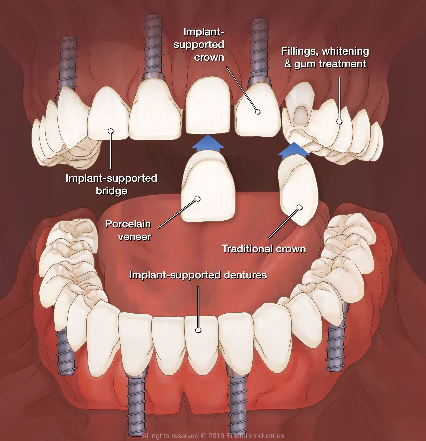 Full Mouth Reconstruction