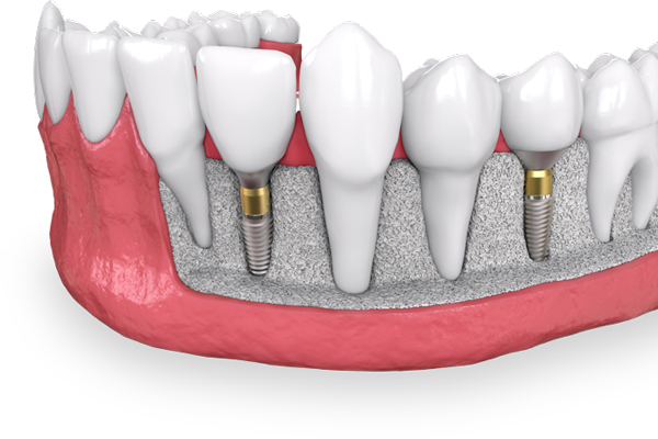 Illustration of dental implant in jaw