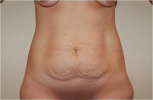 before tummy tuck