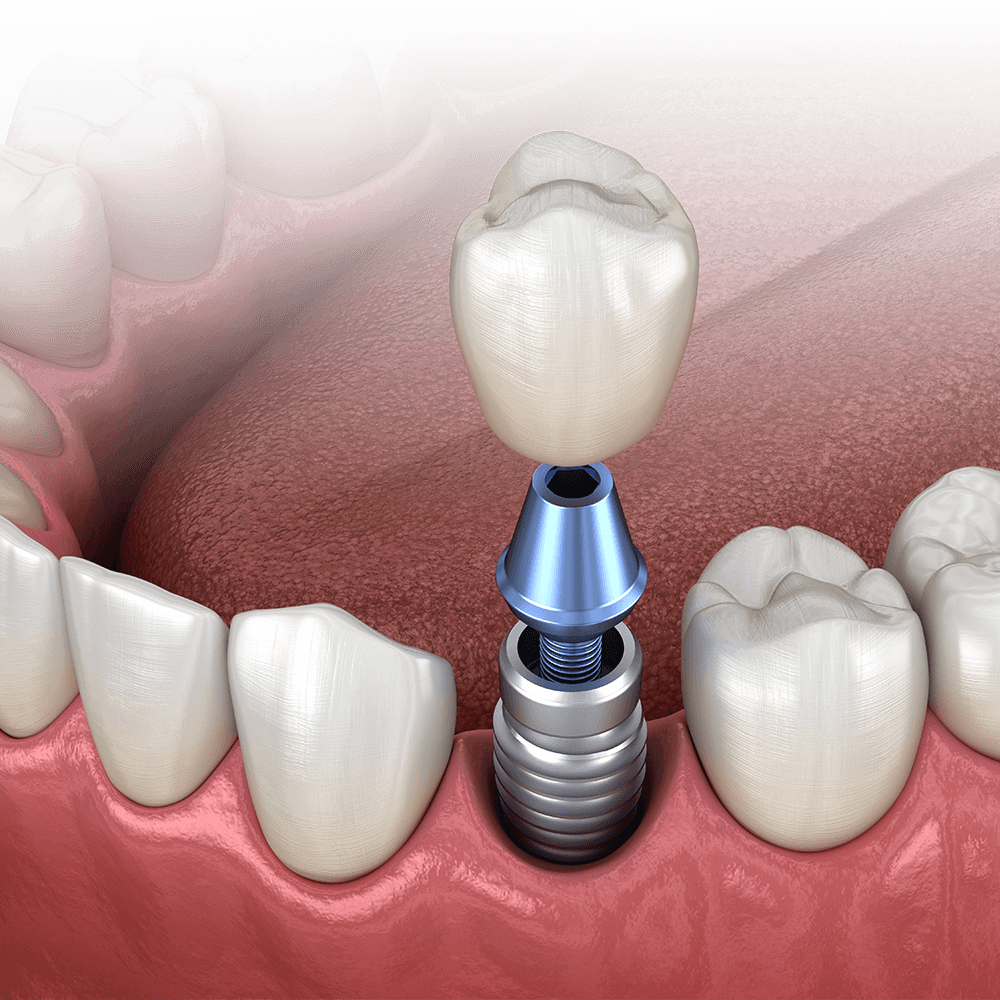 Dental implant