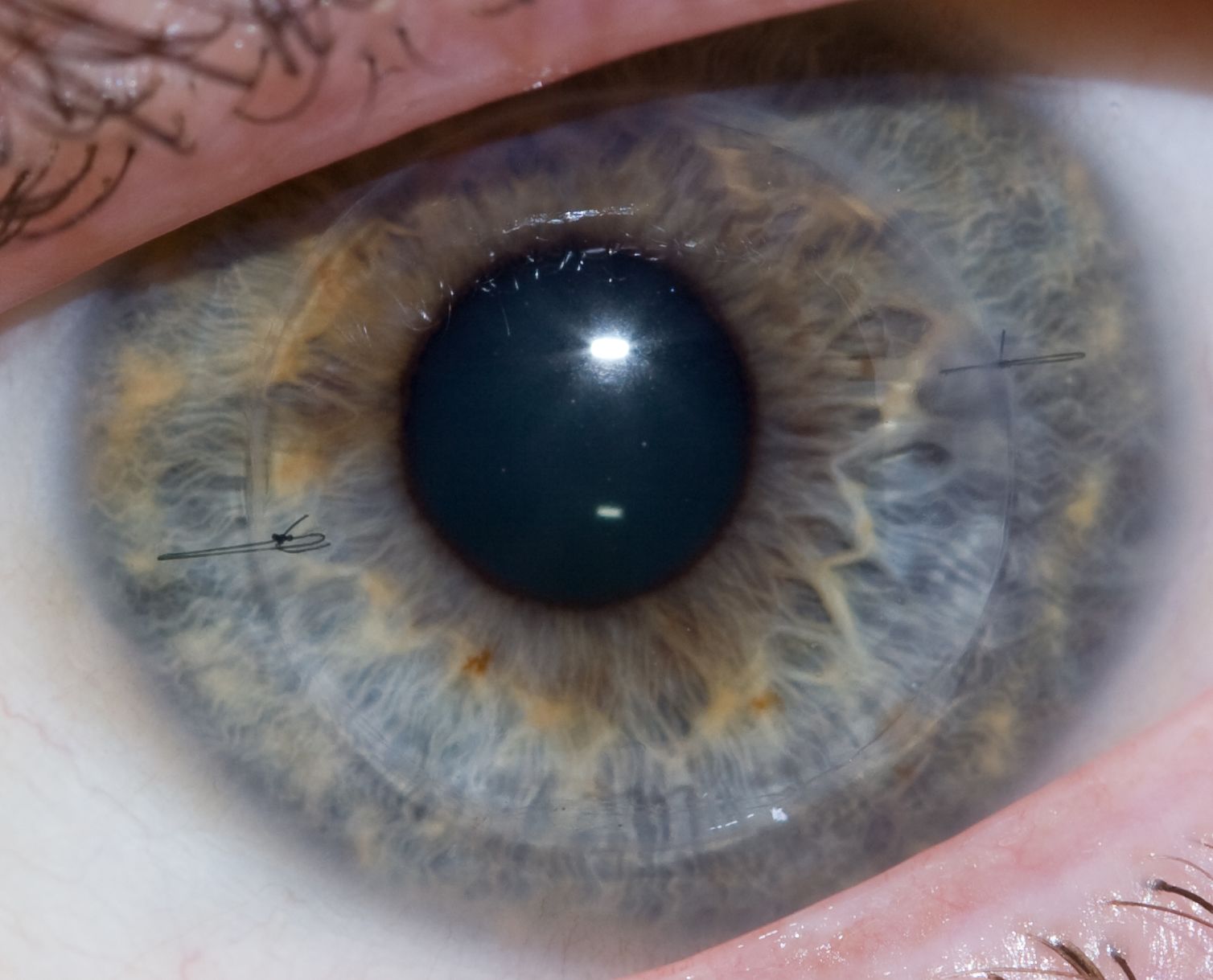 Close-up of an eyeball with two fine sutures