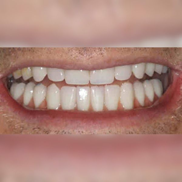 After photo of Hybridge dental implants patient