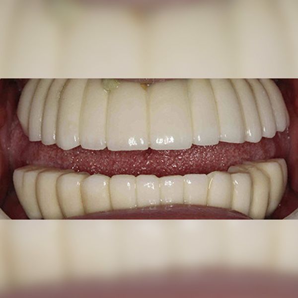 Before photo of hybridge dental implants patient