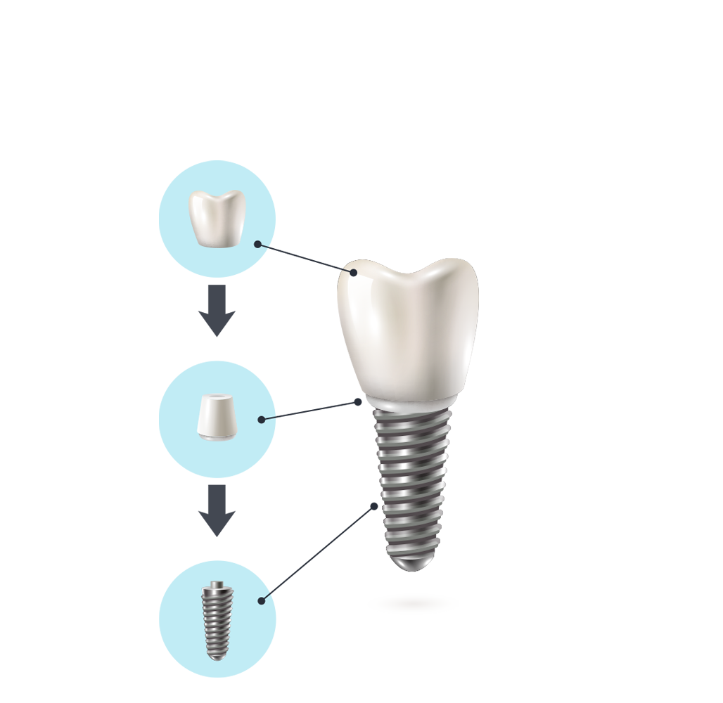 Dental implant, abutment and crown