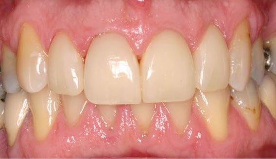 after dental care