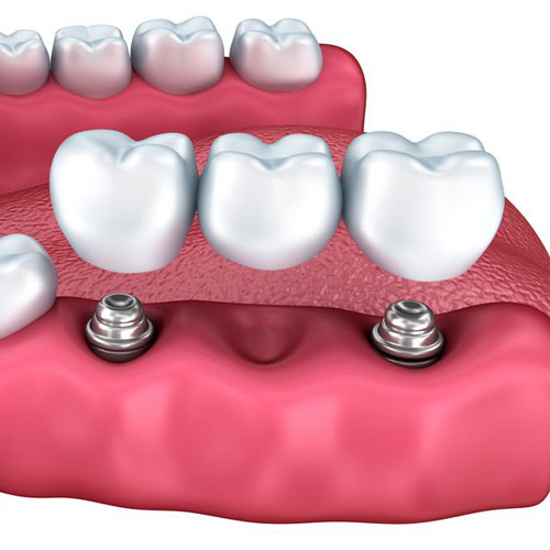 Dental Bridge