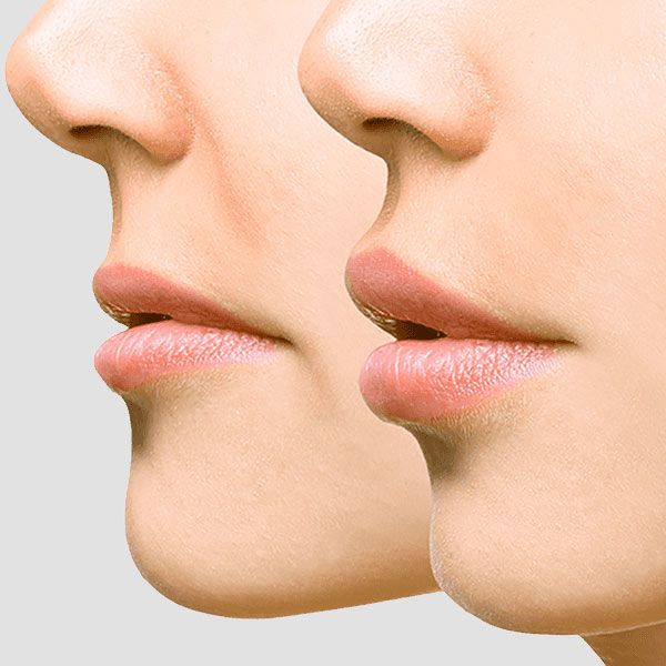 Before and after lip implants