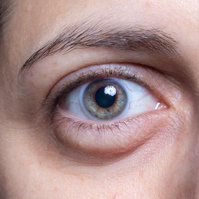 Eye with signs of aging