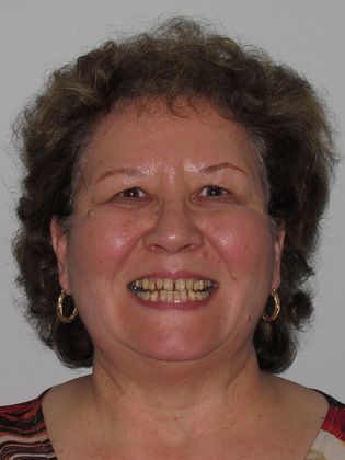 Before smile makeover