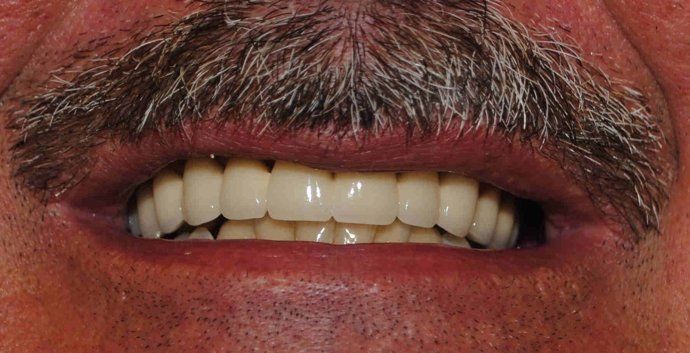 After smile makeover