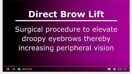 Direct Brow Lift Video