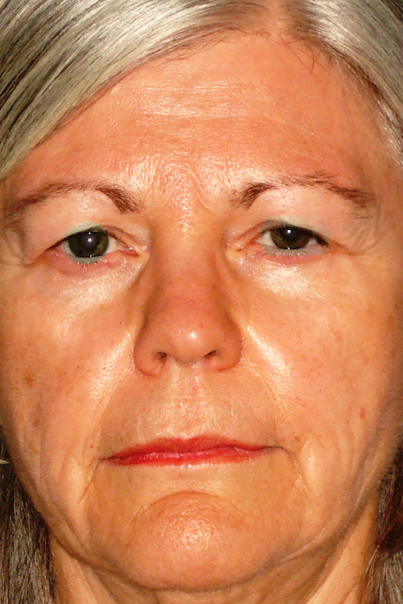 A pre-eyelid surgery photo of a female patient