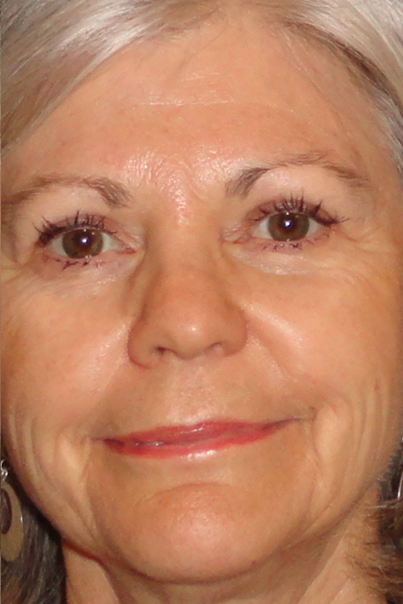 A post-eyelid surgery photo of a female patient
