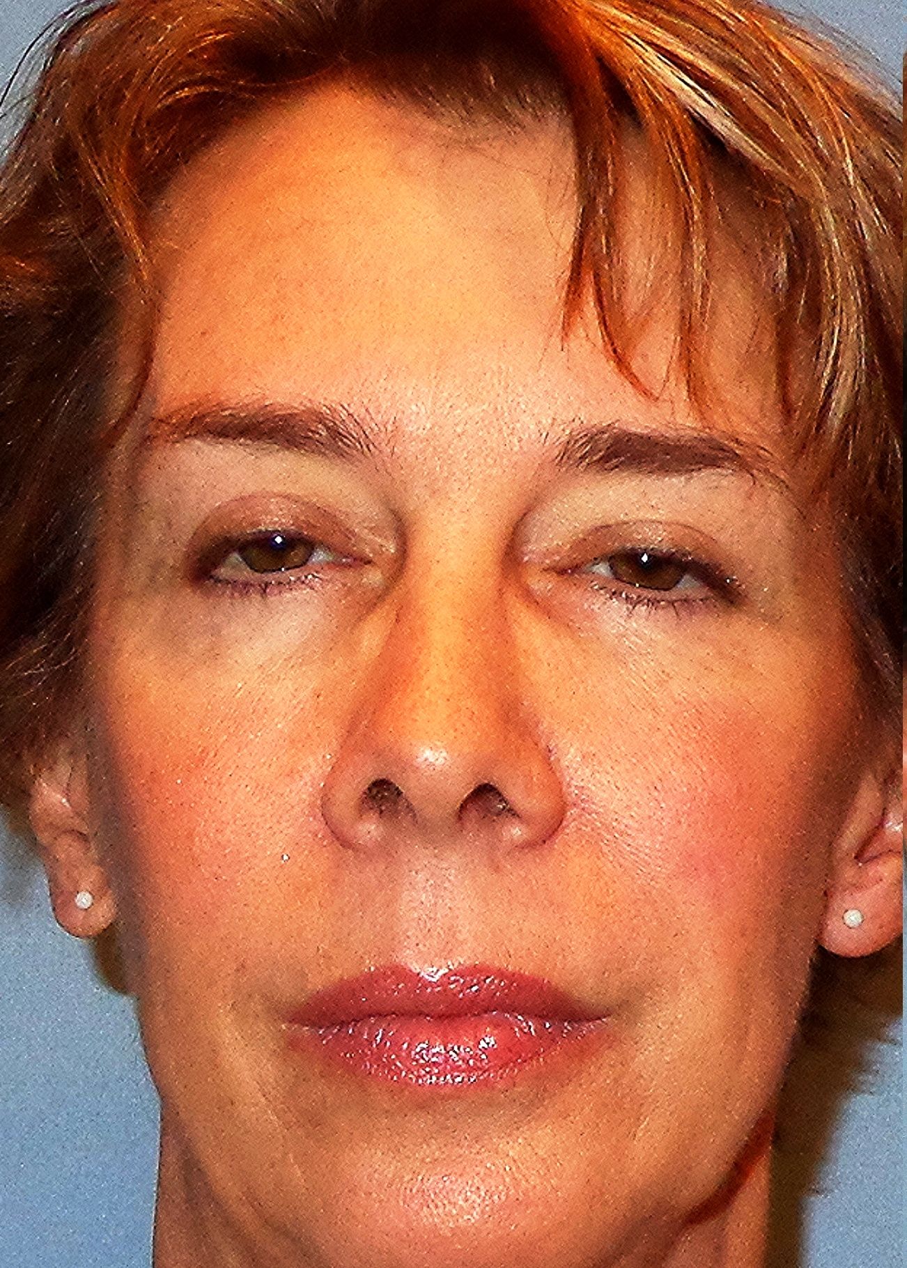 Before Muller Surgery