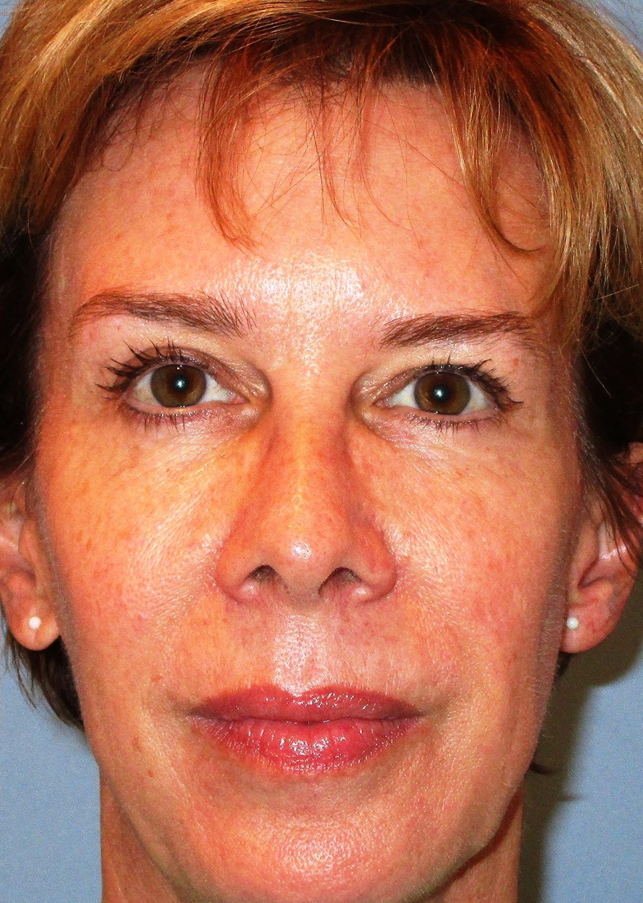 After Muller Surgery