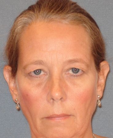 Before Eyelid Surgery