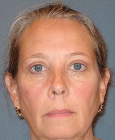 After Eyelid Surgery