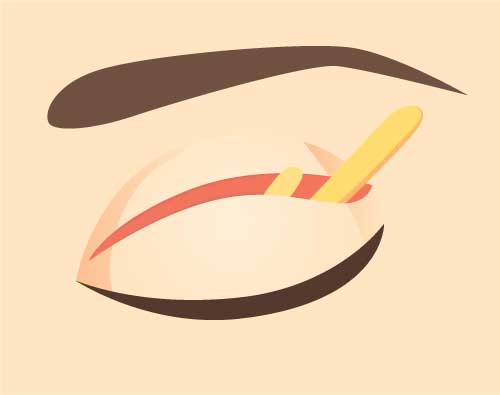 Illustration of surgery