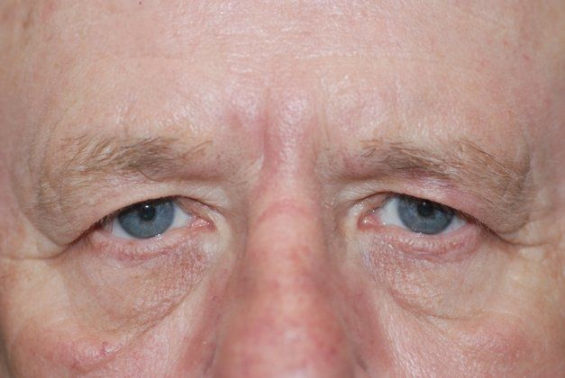 Before eyelid surgery