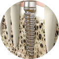 Osseointegration
