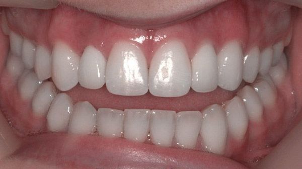 after dental implant treatment