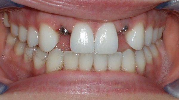 before dental implant treatment