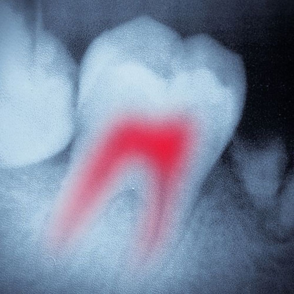 X-ray of tooth with infected root canal