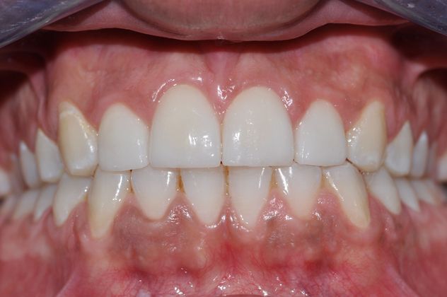 After porcelain veneers