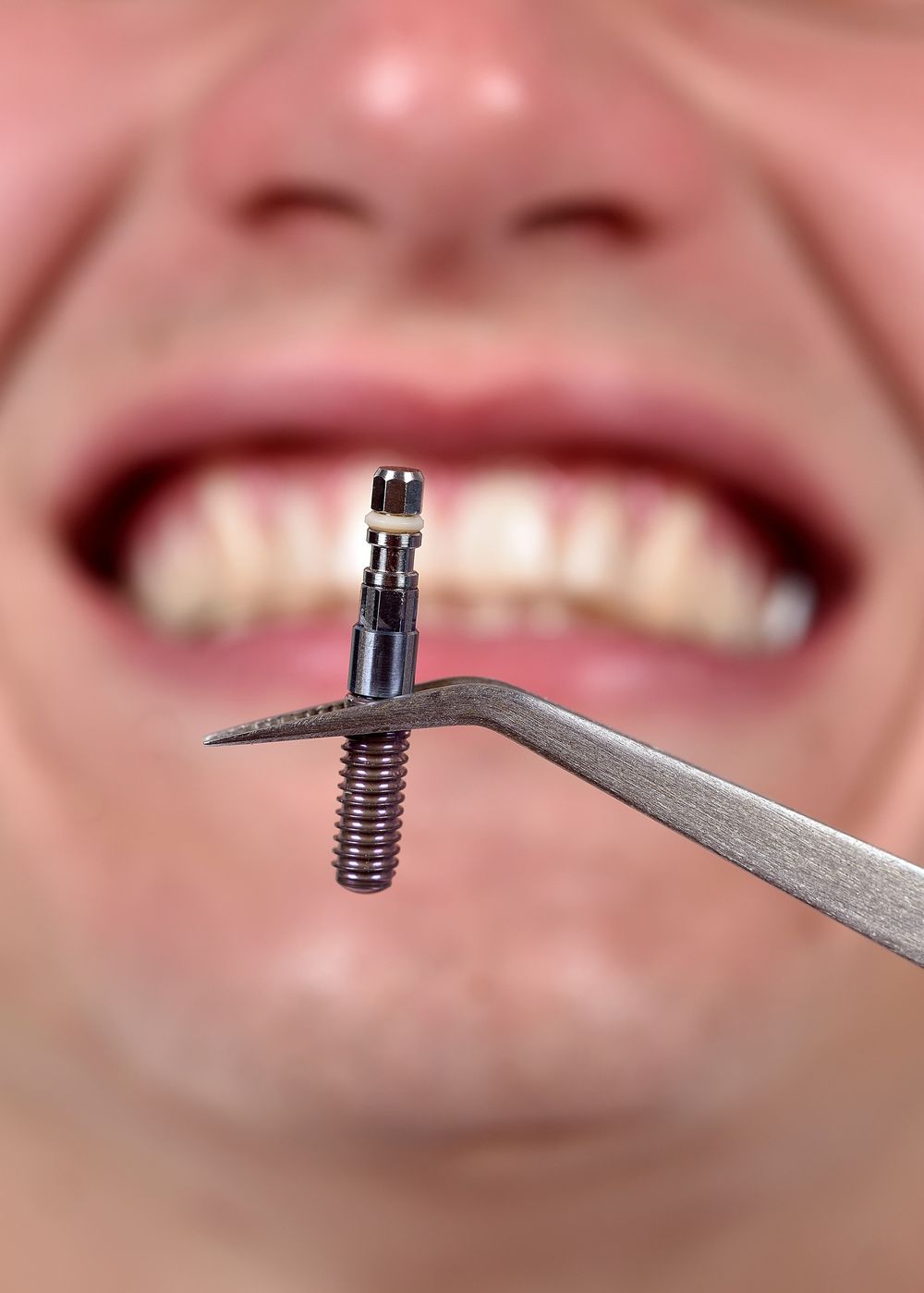 blurred man's smile with dental implants