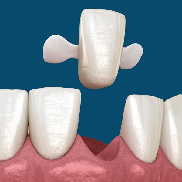 Maryland Bonded Dental Bridge