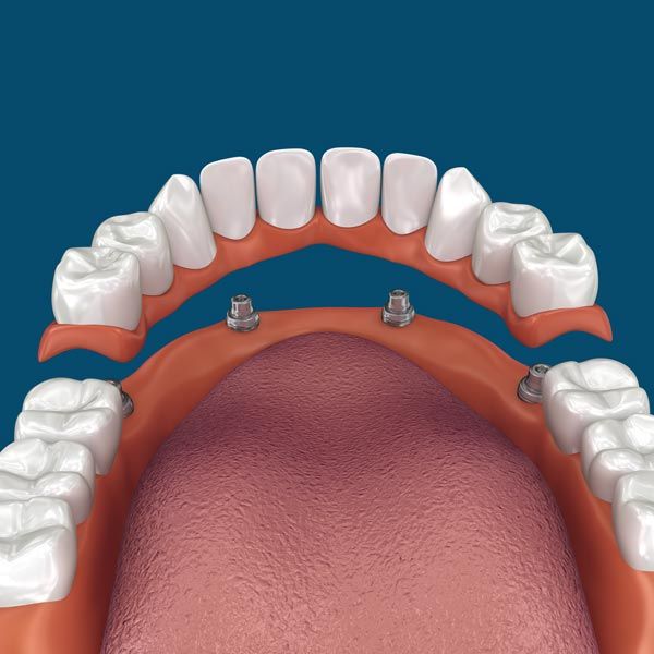 Prettau® Zirconia Dental Bridges