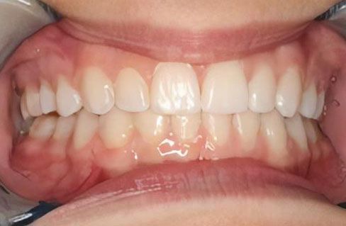 A patient's beautiful smile after braces