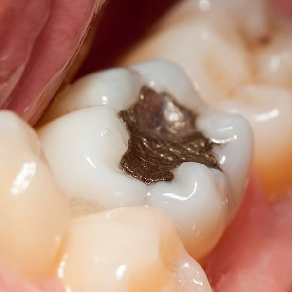 dental filling