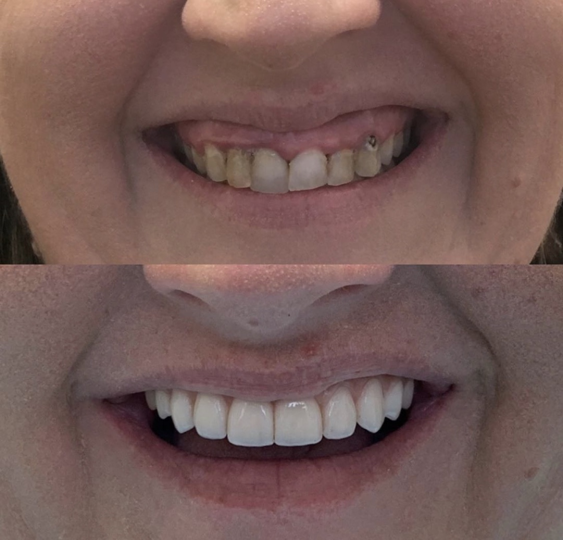 High End Dentures Near Me  : Loose Dentures Can Be A Nightmare.