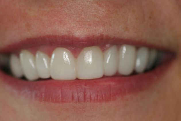 After veneers