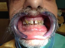 Close-up of a man's teeth prior to cosmetic treatment.