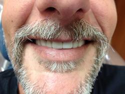 Close-up of a man's teeth after cosmetic treatment.
