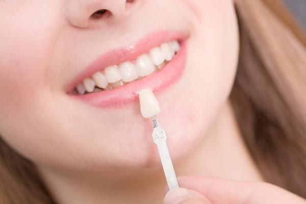planning veneers treatment
