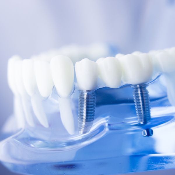 Implant-Supported Denture