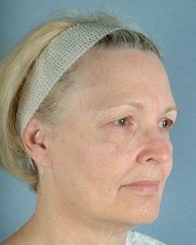 eye lid surgery before